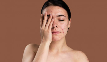 O estresse faz mal para saúde da pele? SIM!